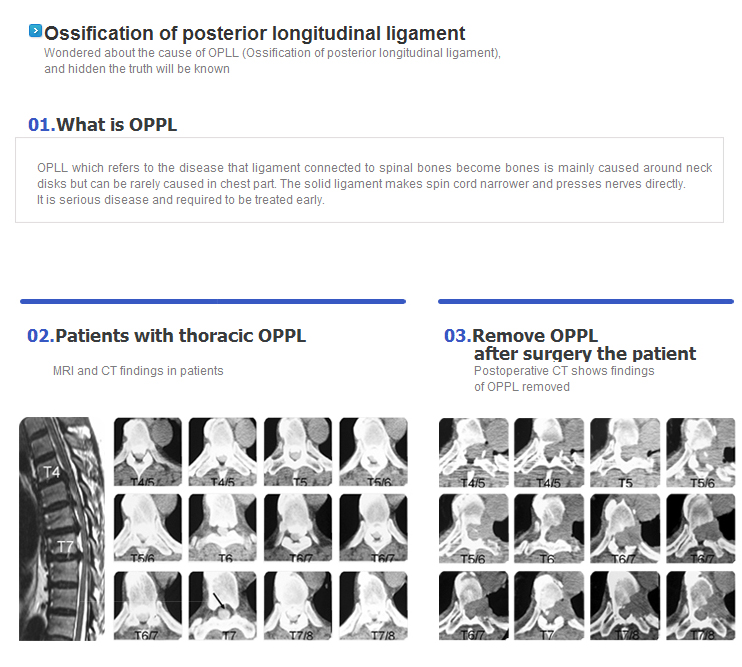 Ossification of posterior longitudinal ligament
