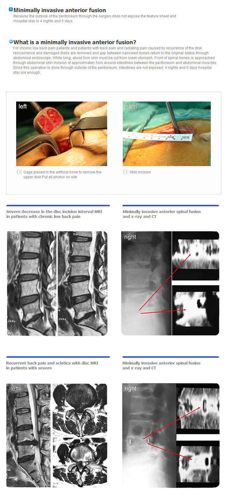 Minimally invasive anterior spinal fusion